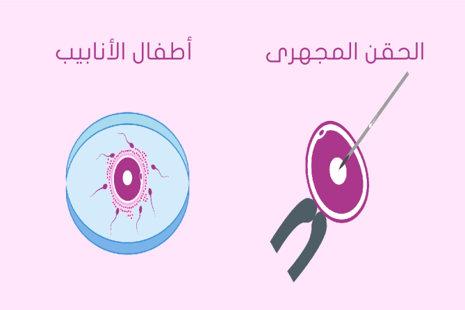 الحقن المجهري واطفال الانابيب